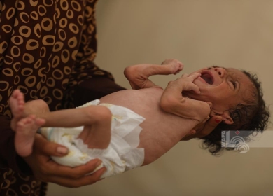 11 حالة وفاة نتيجة المجاعة وسوء التغذية خلال الساعات الـ24 الماضية