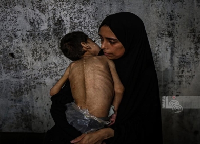 3 وفيات نتيجة المجاعة وسوء التغذية خلال الـ24 ساعة الماضية